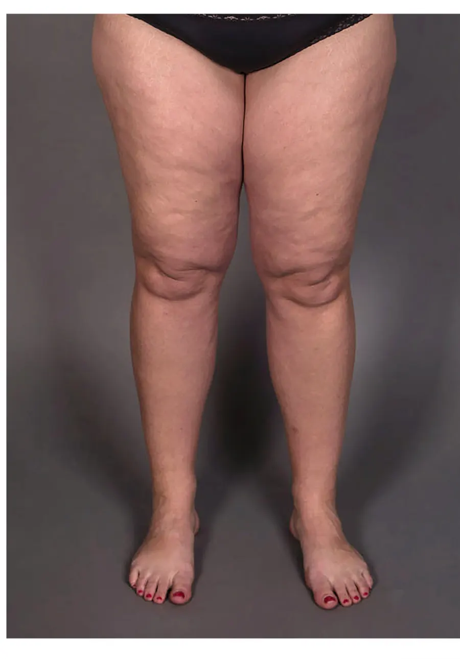 Pernas com lipedema — imagem ilustrativa da condição (Wikimedia Commons, CC BY-SA 4.0)